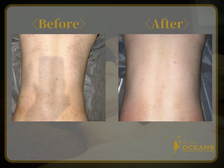 メンズ脱毛サロンOCEANS 背中脱毛のBefore-After画像