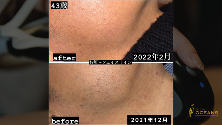メンズ脱毛サロンOCEANS　ヒゲ脱毛のbefore-after