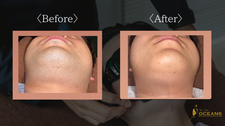 メンズ脱毛サロンOCEANSでの首脱毛