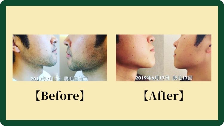 メンズ脱毛サロンOCEANSでの顔脱毛 Before-After写真