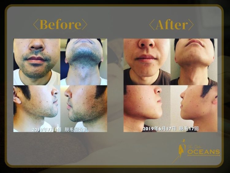 顔毛before-after